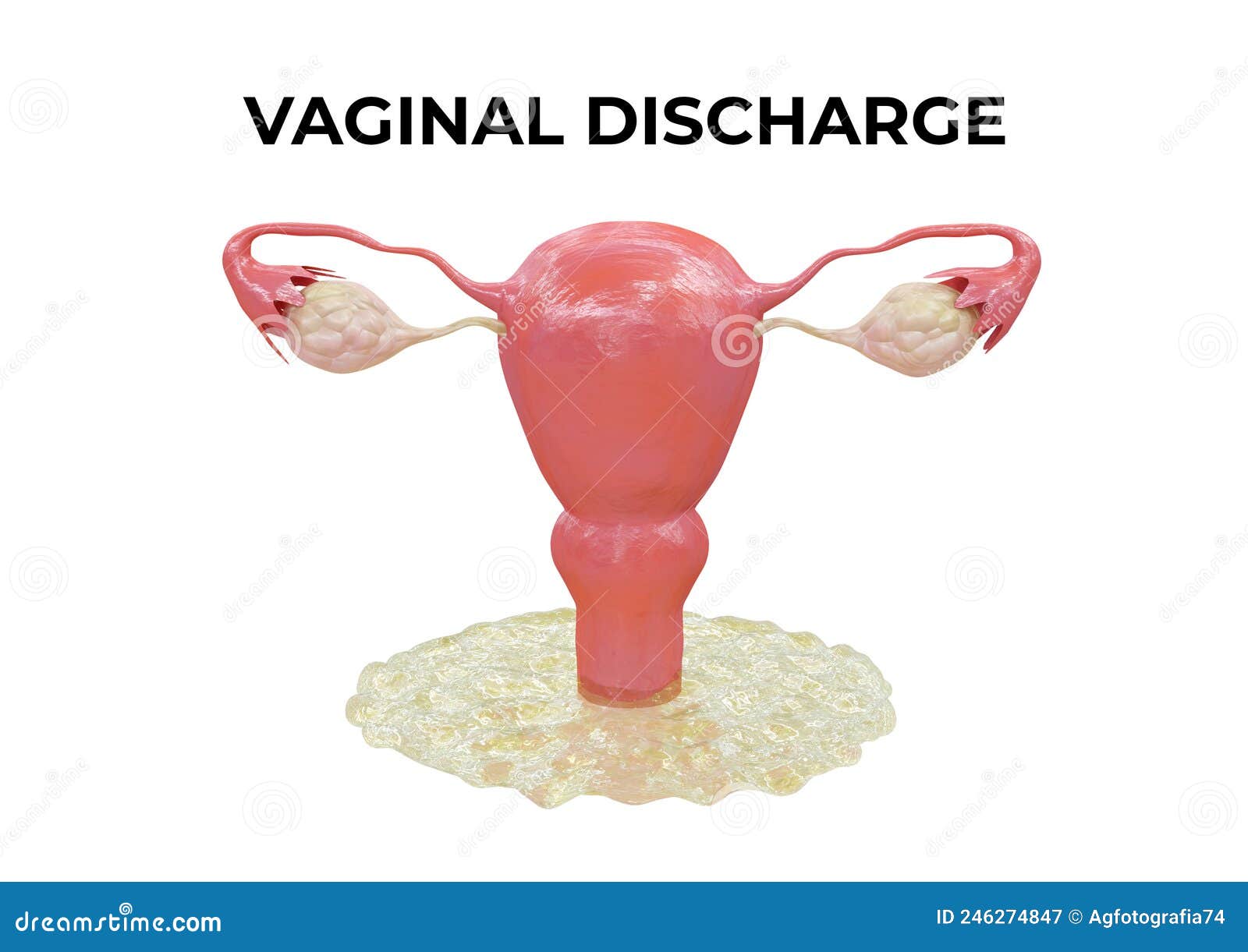 Vaginal Discharge is Excess Fluid and Cells from the Vagina that Ranges  from Whitish and Sticky To Clear and Watery in Color Stock Illustration -  Illustration of enlarged, infection: 246274847