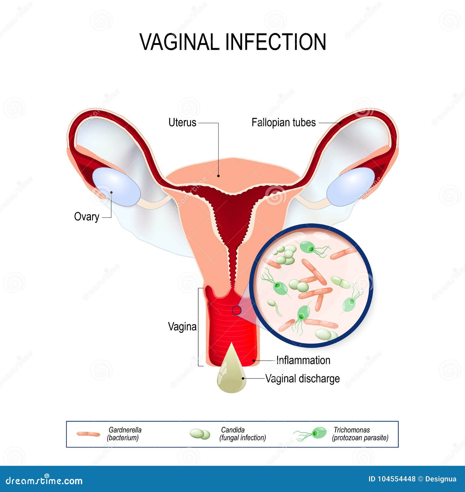 vaginal infection and causative agents of vulvovaginitis.