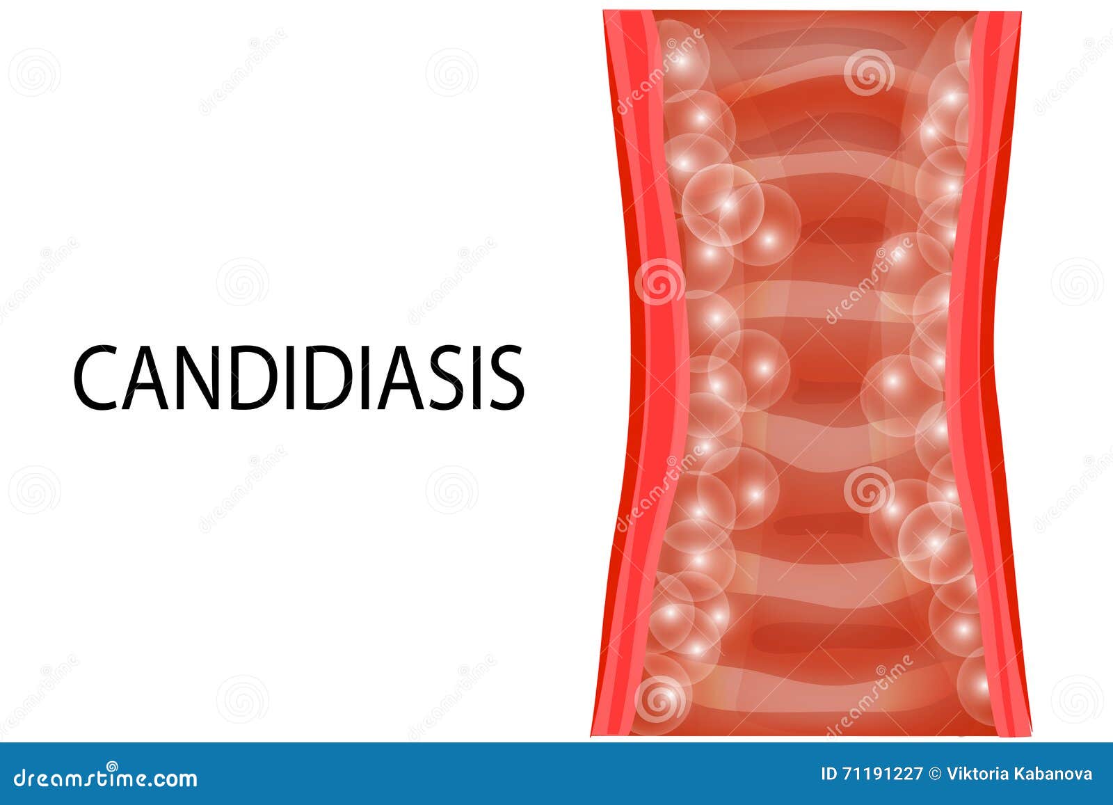 vaginal mucosa of the patient of the candidiasis