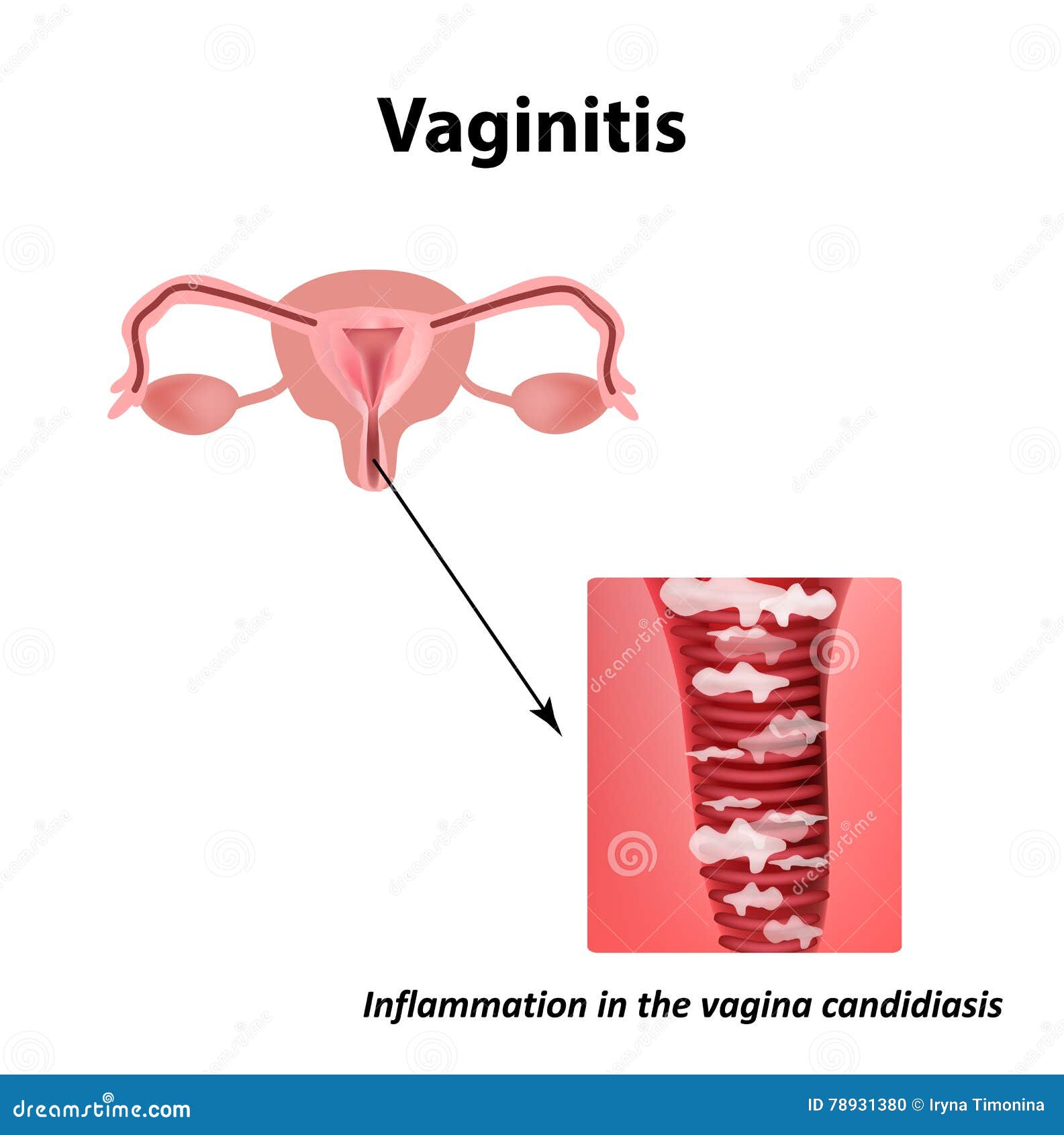 Vaginitis Inflammation In The Vagina Candidiasis Thrush The Structure