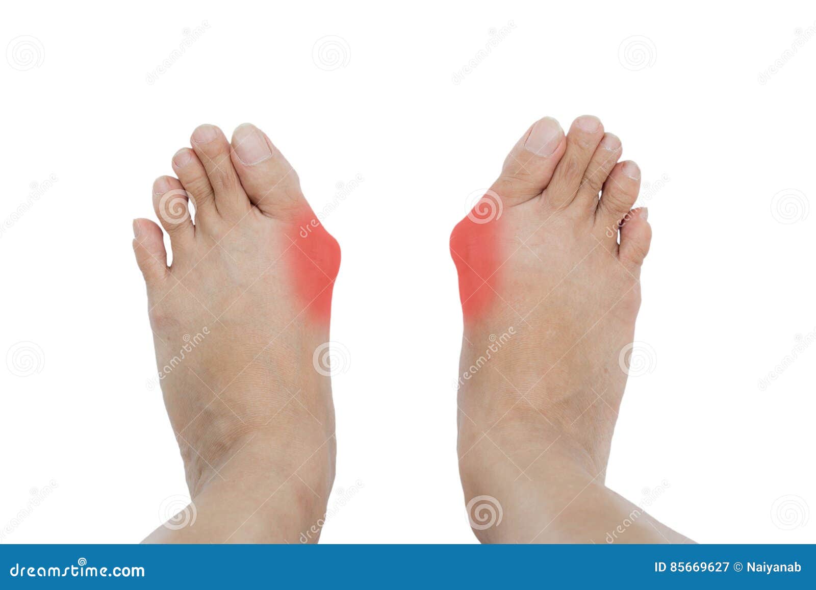 Valgus De Hallux, En Pie Imagen de archivo Imagen de hembra