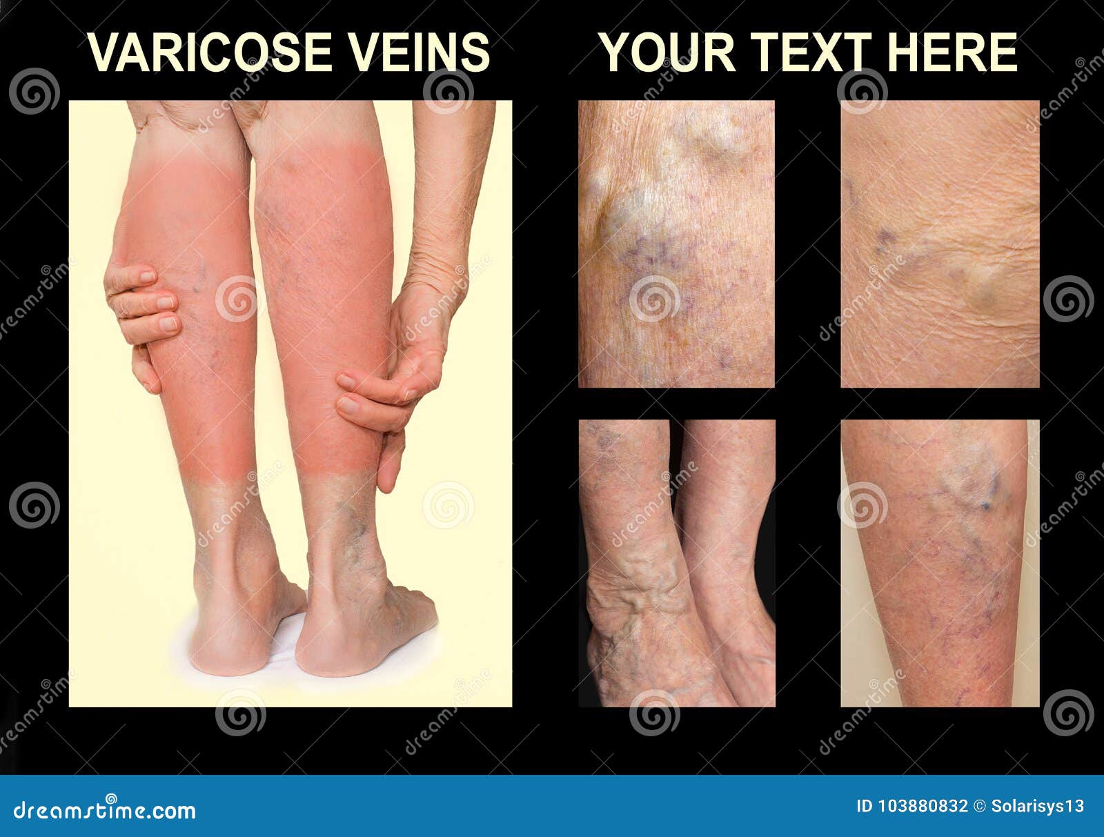 Tipuri de vene varicoase: cum le deosebesti Imagini varicoză pe picioare
