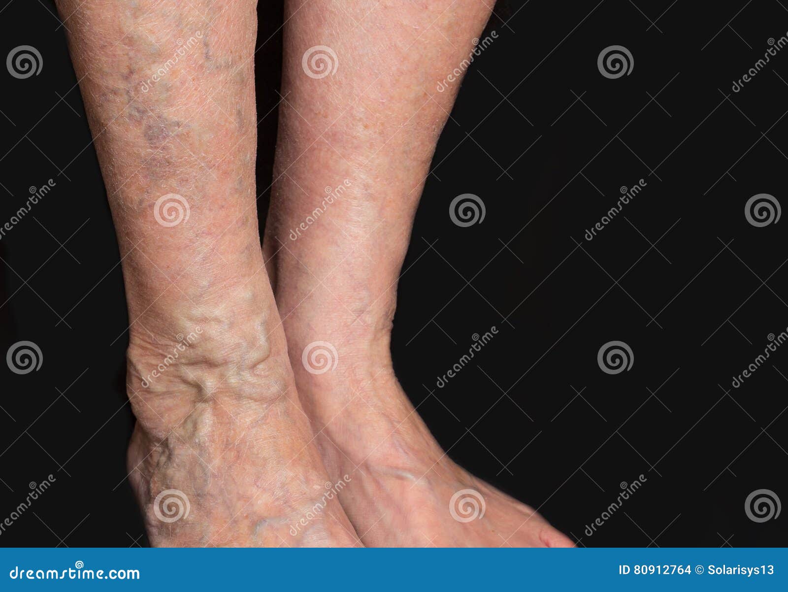 photos varices jambes)