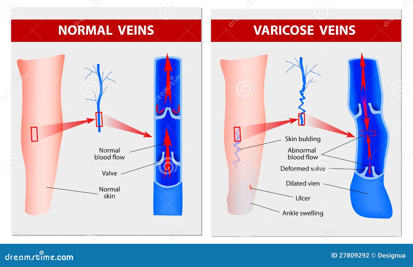 Операция На Вены На Ногах Цена