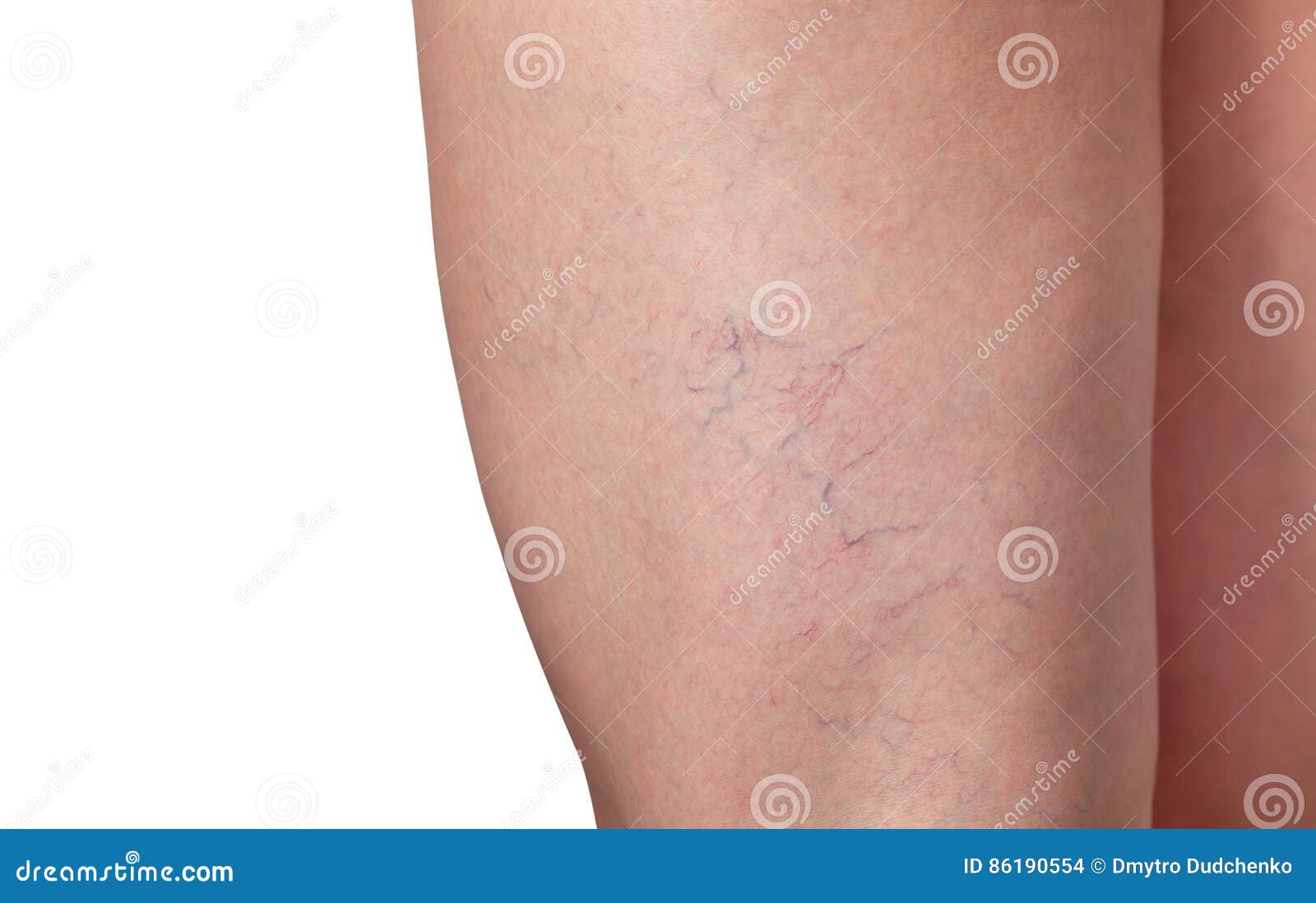 varicose veins and capillary veins in the legs.