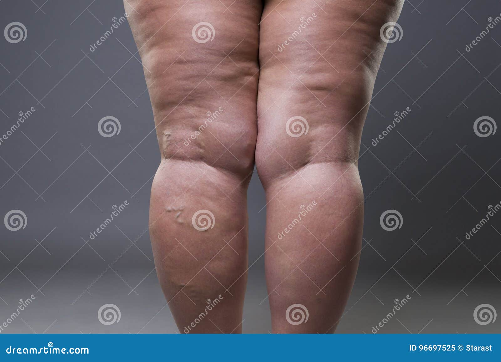 varicose veins closeup, fat female cellulite legs