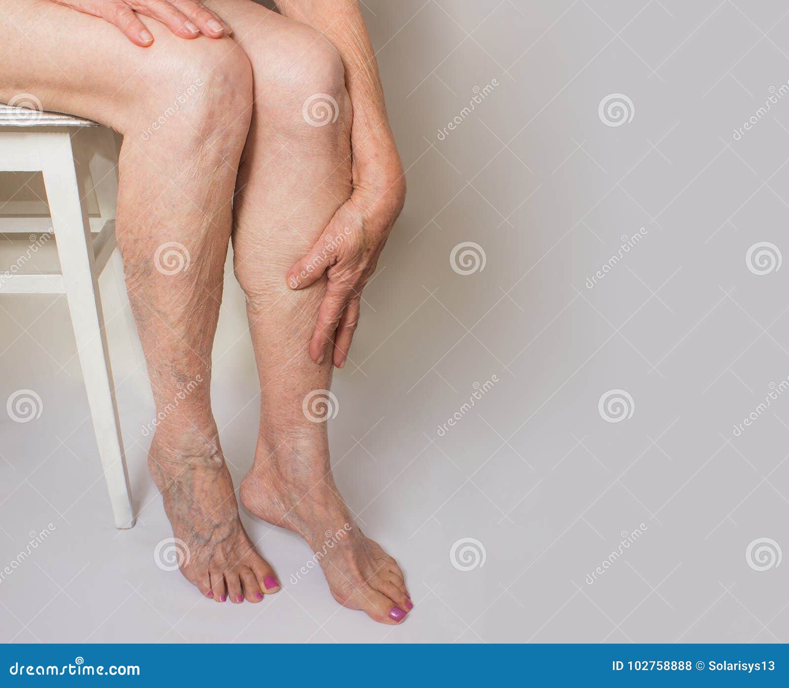 Varicose Veins on a Female Legs Stock Photo - Image of medical