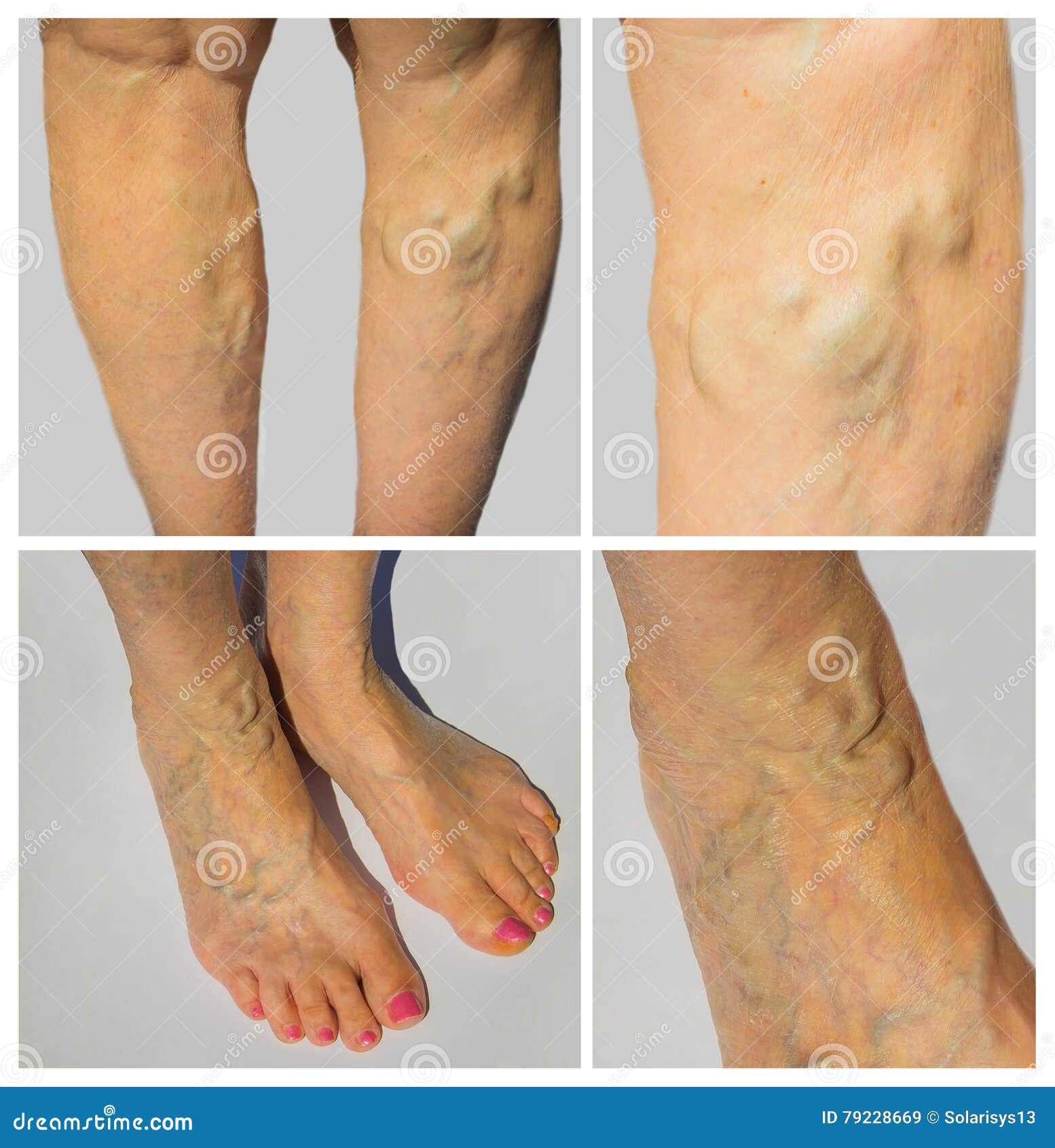 Varicose Veins on a Female Legs Stock Image - Image of care, issue