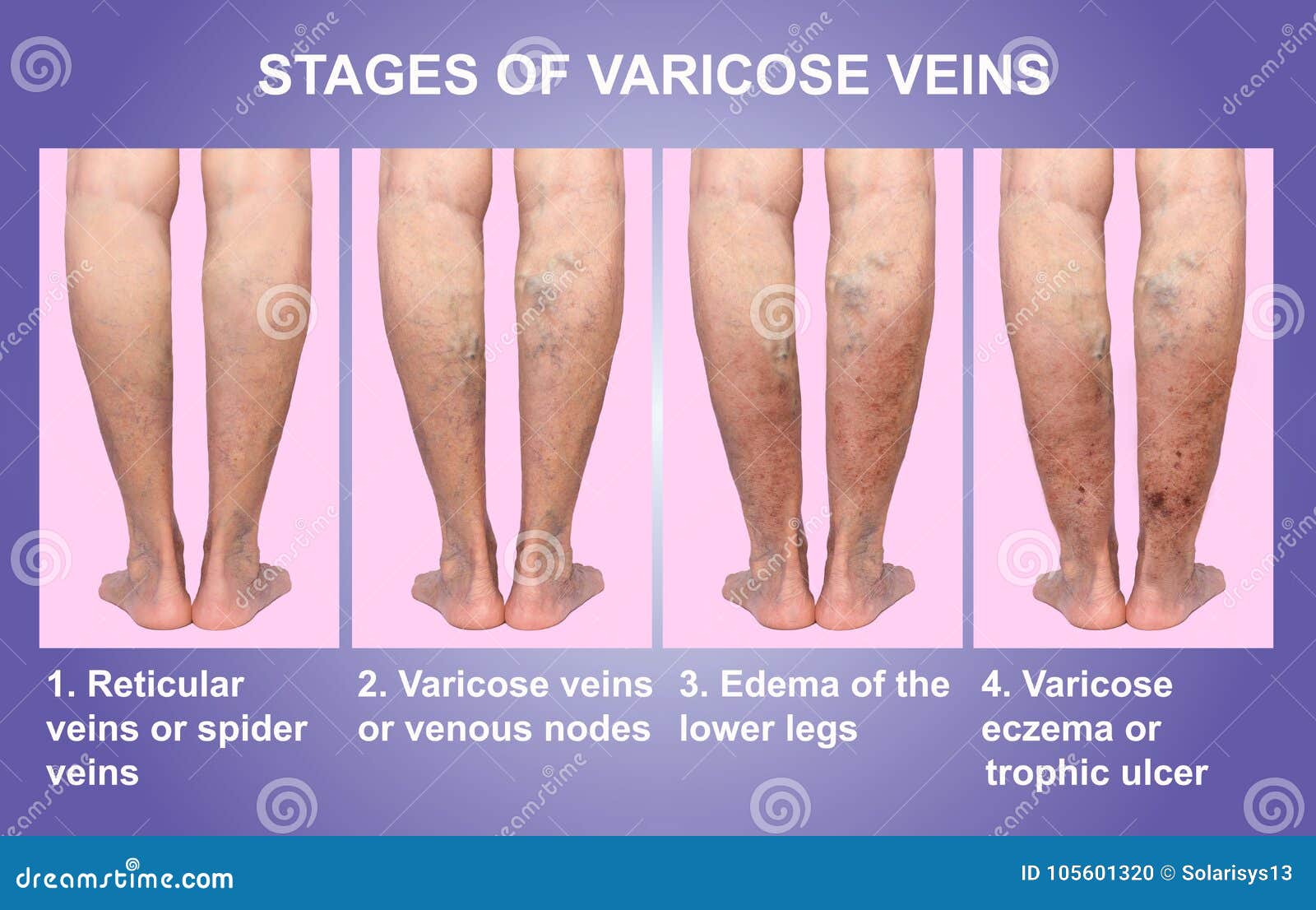 varicoza în diagnosticarea pelvis mica