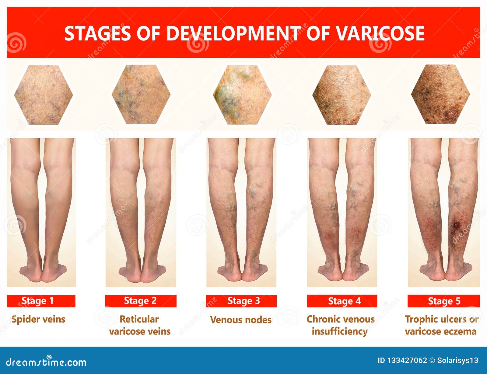 start stage tablete varicoase