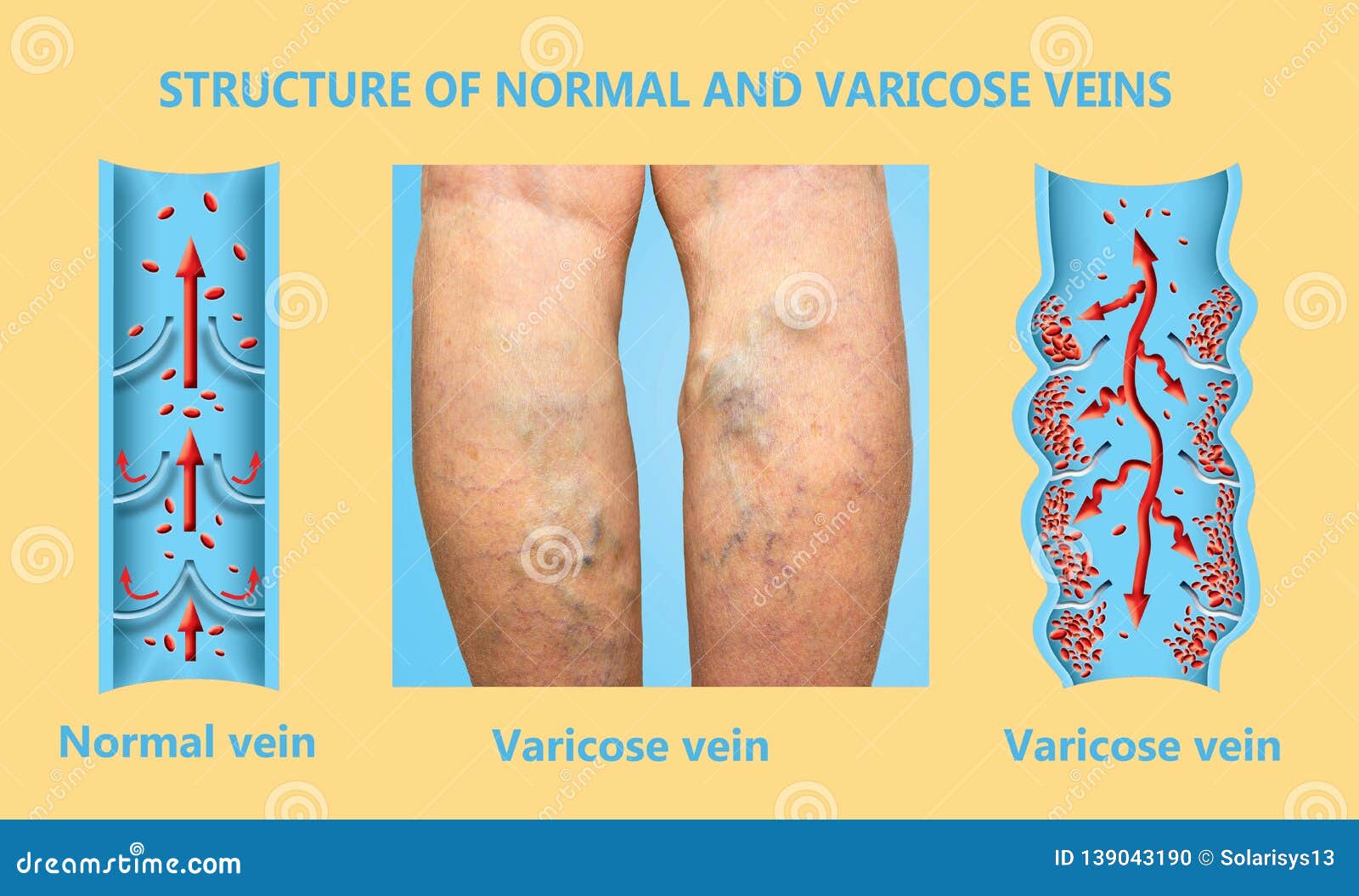deep varicosera de ce se transformă picioarele cu varicoză