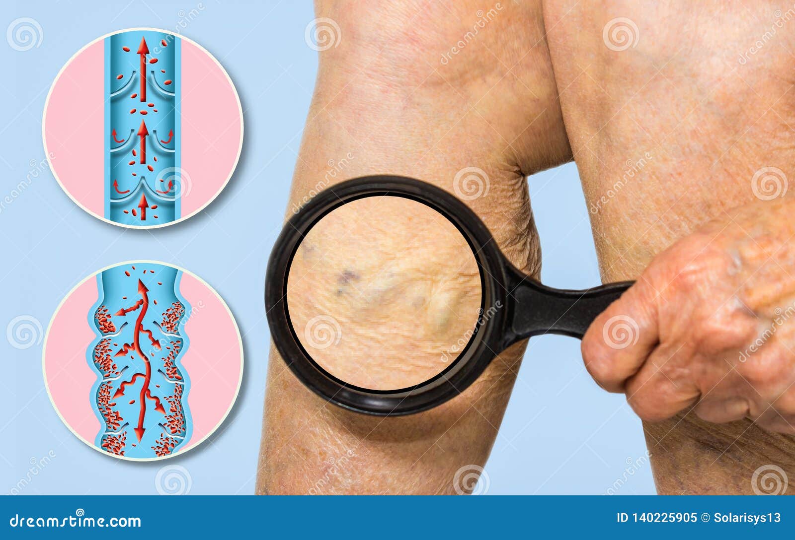 varicose veins on a female senior legs. the structure of normal and varicose veins.