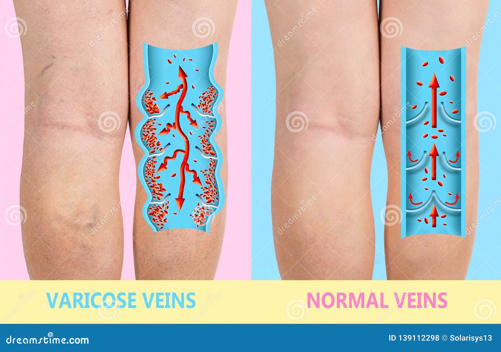 Prominent Dilated Tortuous Veins Called Varicose Stock Photo 1415239970   Shutterstock