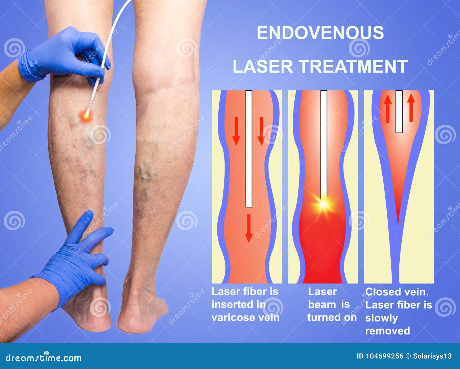 tratamentul lipetsk laser varicose varicose