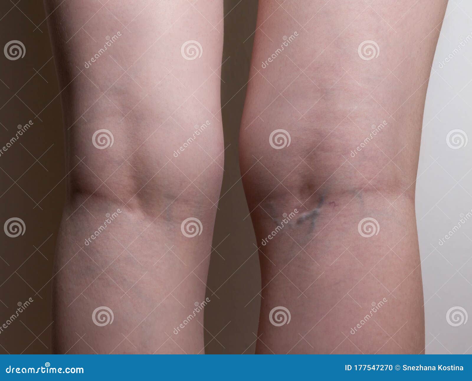 varicoză și musculare fotografii pentru picioare varicoase la femei