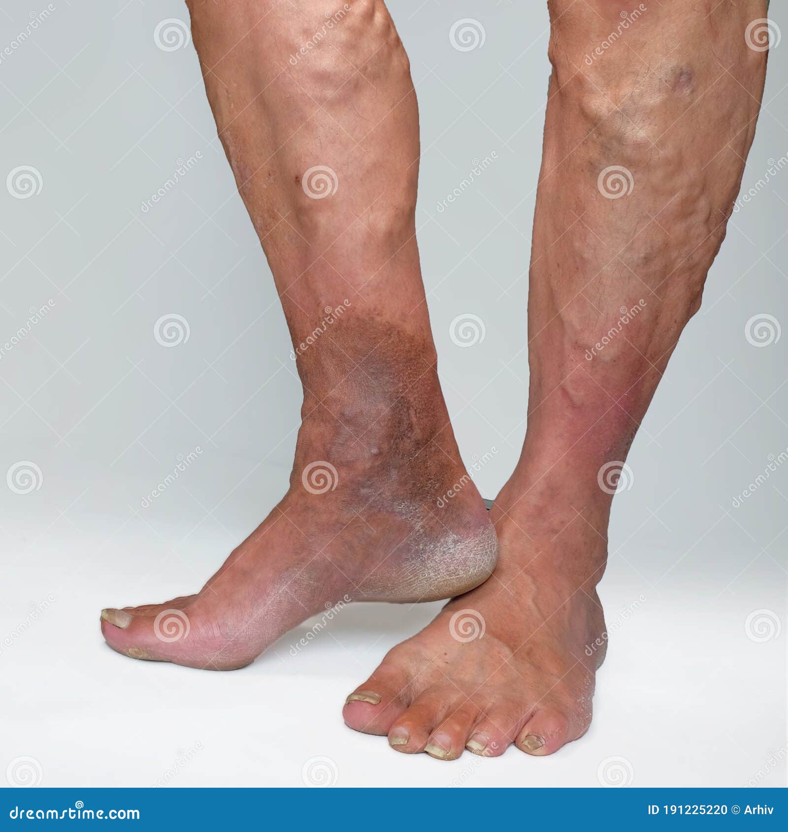 varicose veins of the lower extremities)