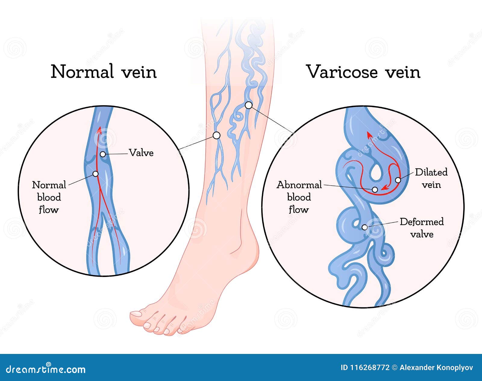 cosmetologie i vene varicoase