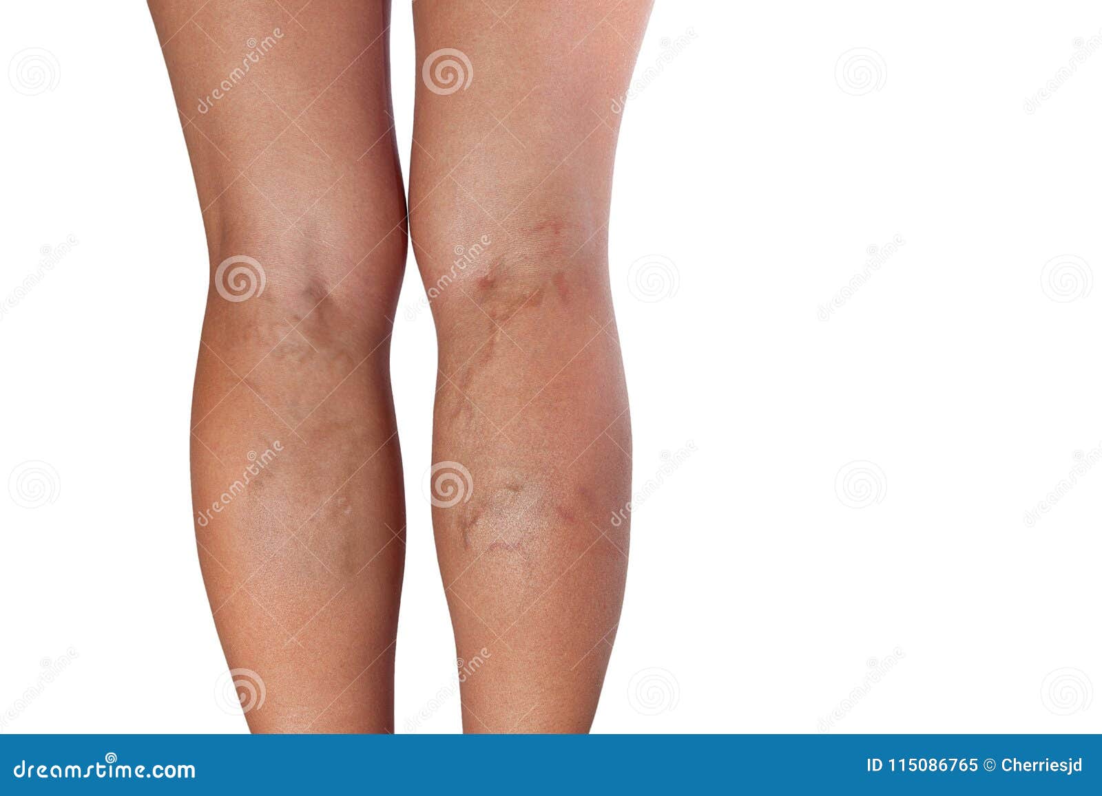 varicose veins of woman legs