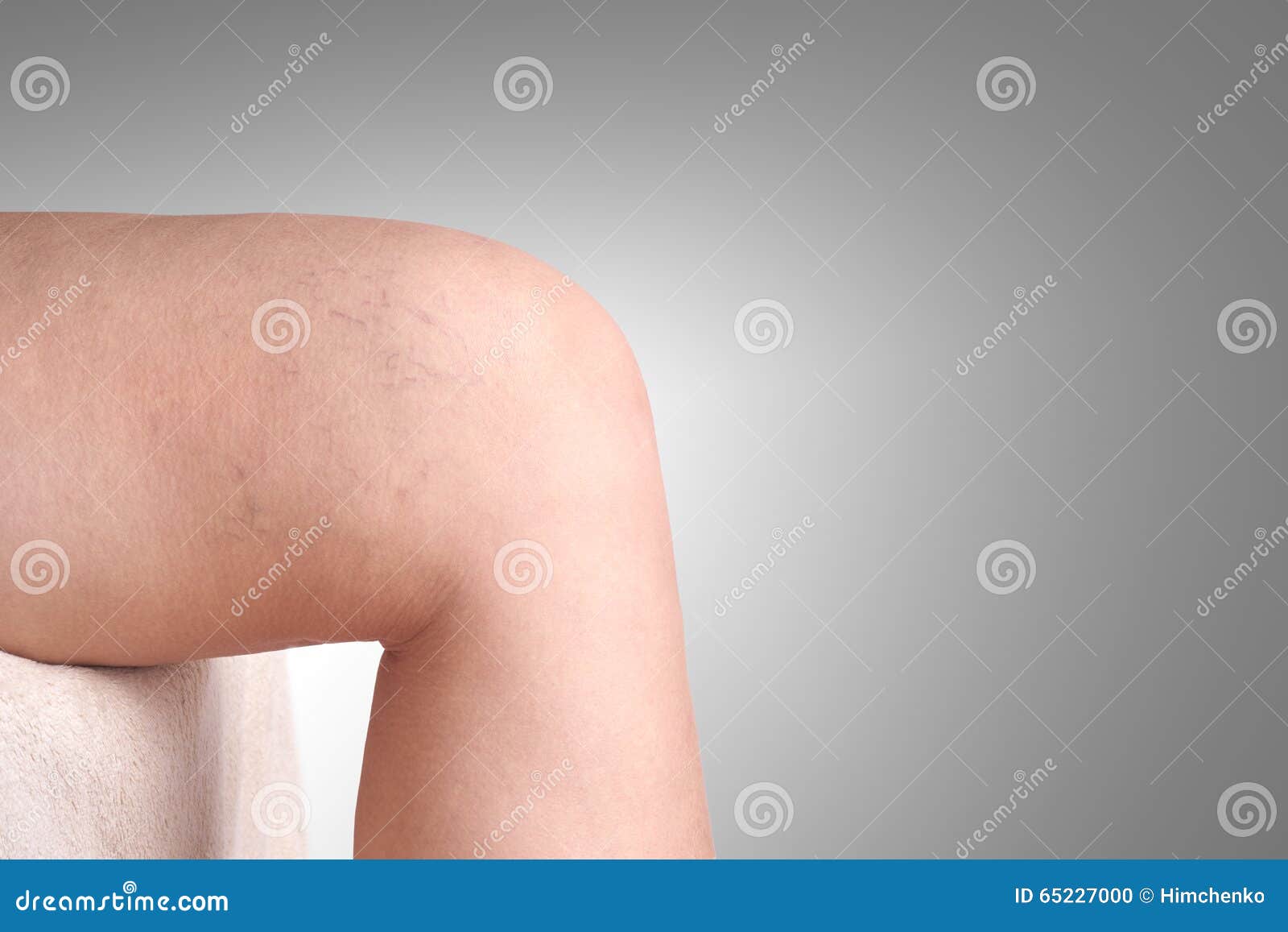 345 Women Varicose Veins Leg Stock Photos - Free & Royalty-Free Stock  Photos from Dreamstime