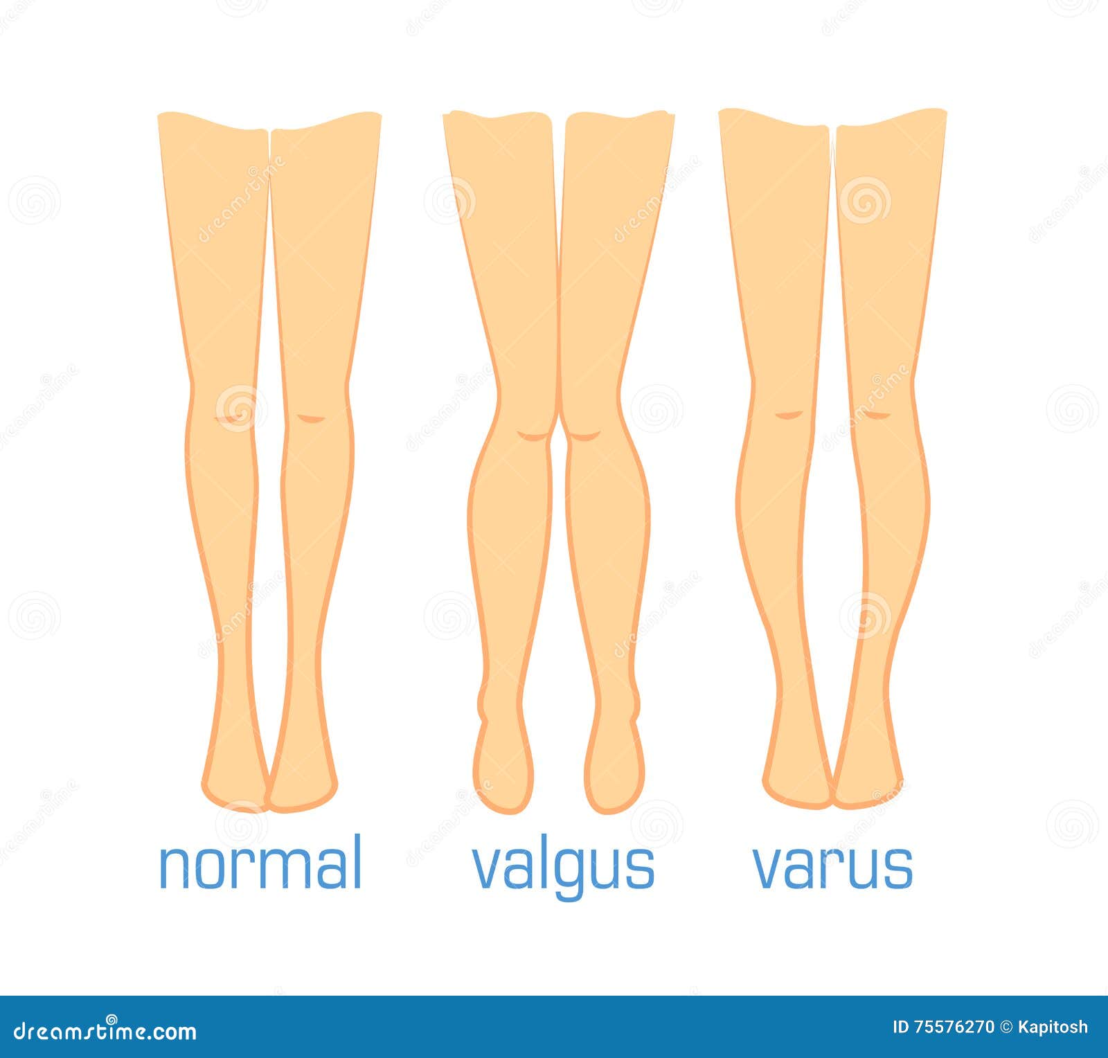 Varus und Normal Valgus vektor abbildung. Illustration von knie 75576270