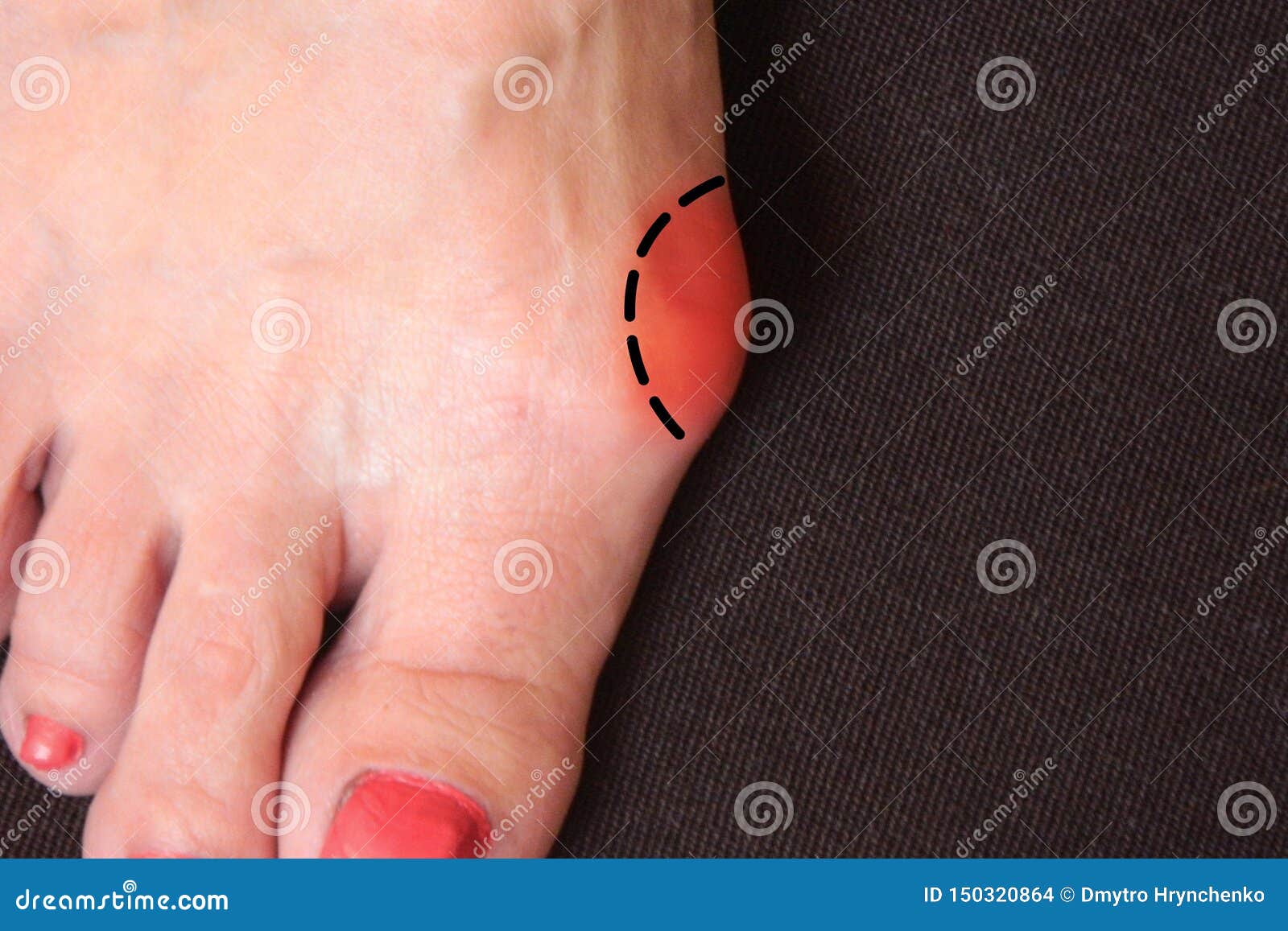 Varus Valgus和hallux Valgus或者囊炎在中间年迈的妇女脚在黑暗的背景的被隔绝的特写镜头治疗的概念或库存照片 图片包括有 Varus Valgus和hallux Valgus或者囊炎在中间年迈的妇女脚在黑暗的背景的被隔绝的特写镜头治疗的概念或库存照片 图片包括有