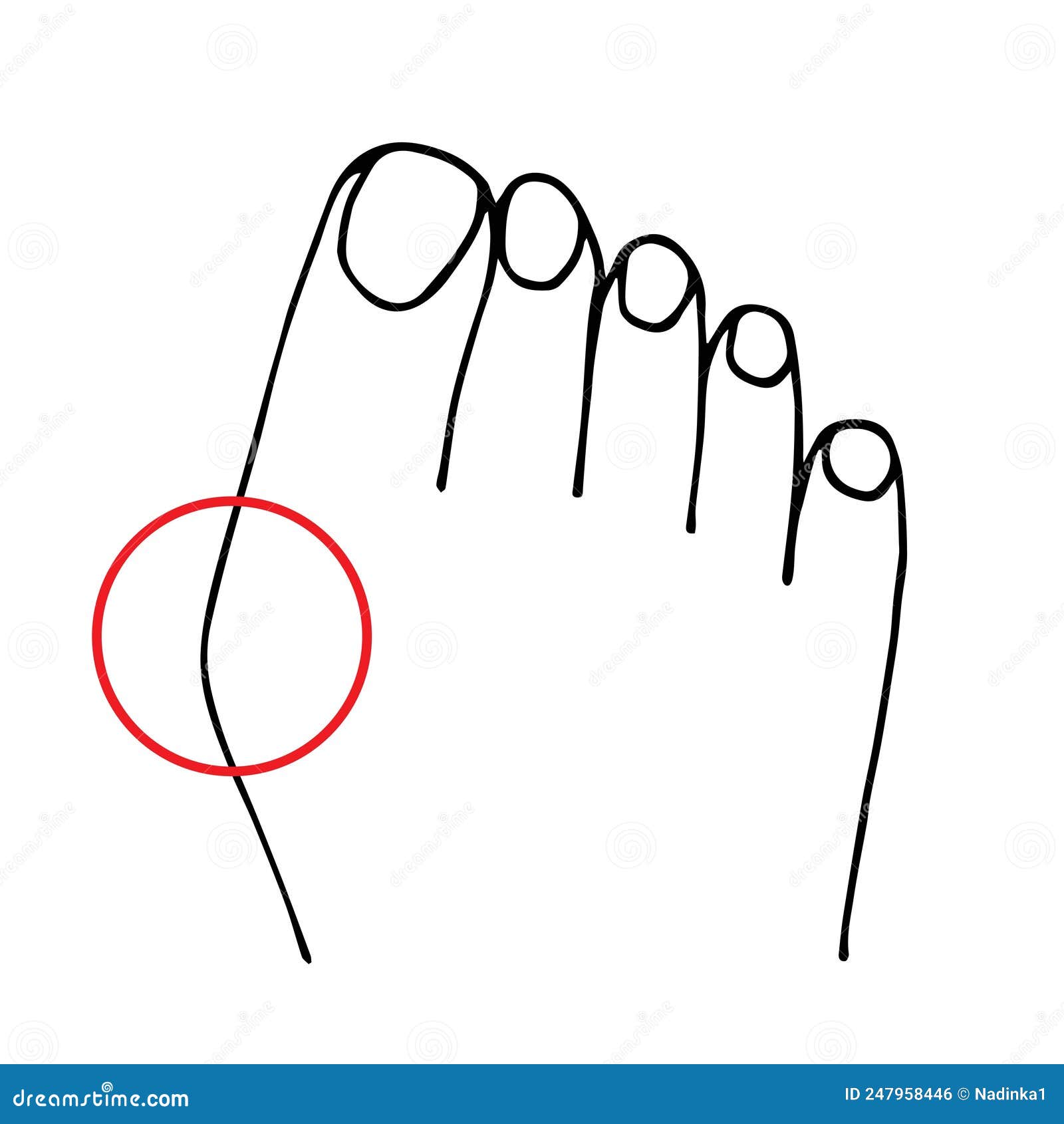  black outline drawing. hallux valgus, deformity of the big toe, curvature of the plus phalangeal joint. medicine and