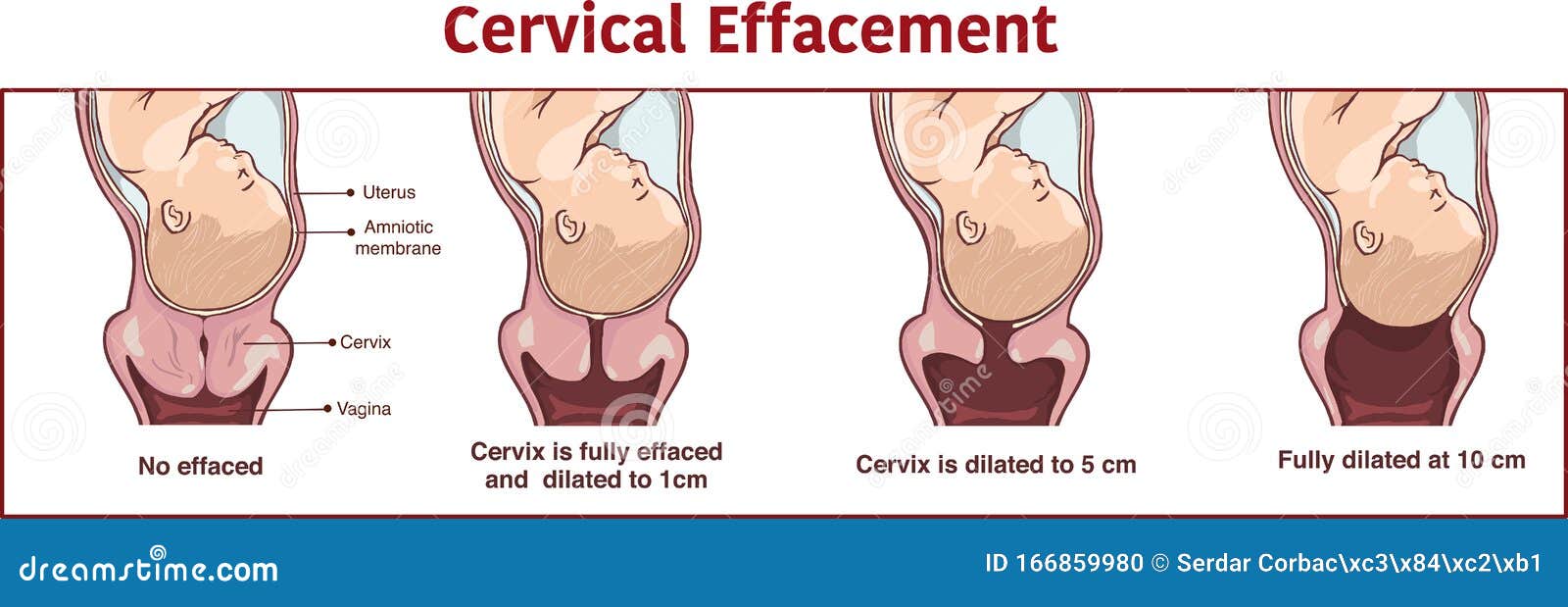  - cervical effacement and dilatation during labor