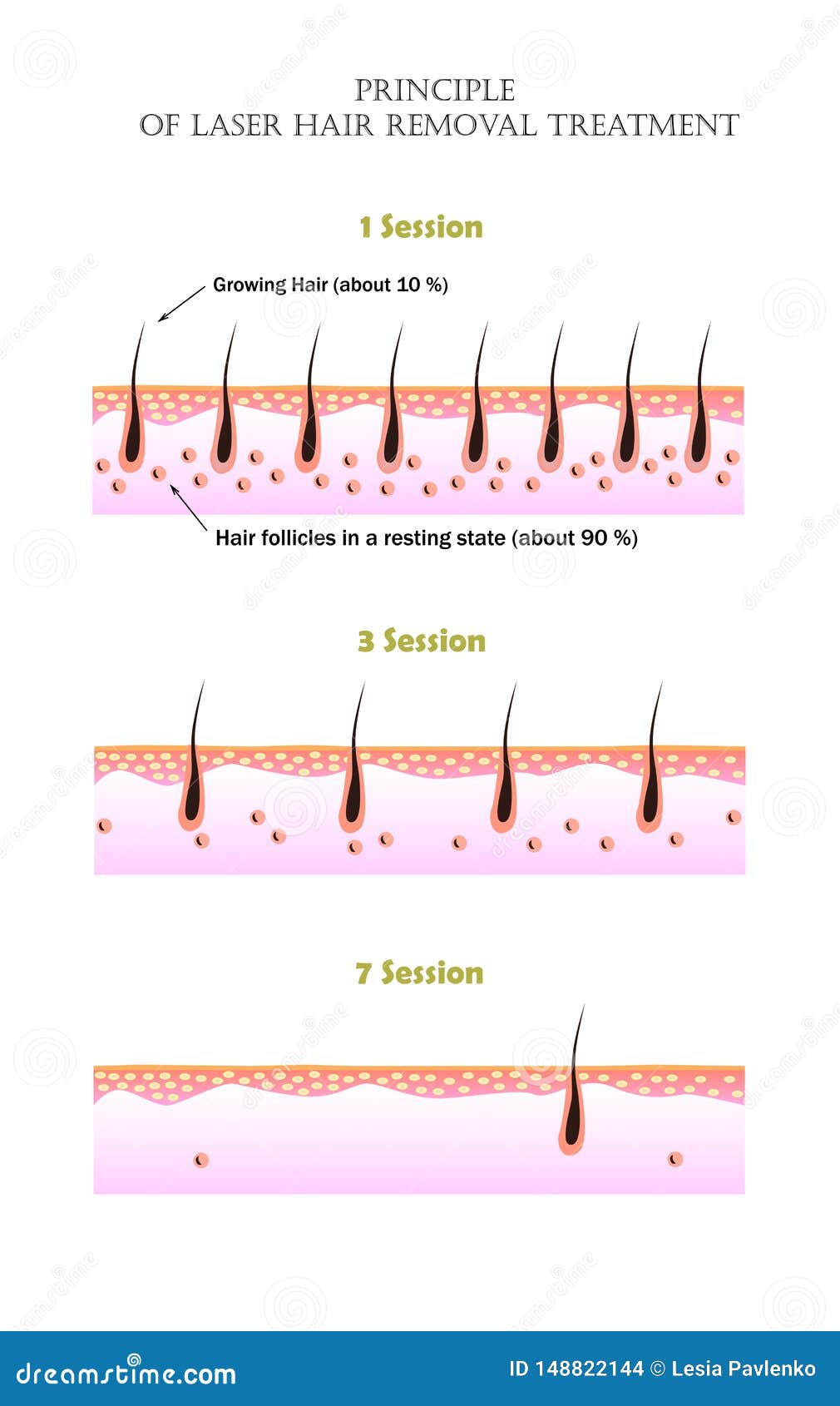 Laser sesion clearance