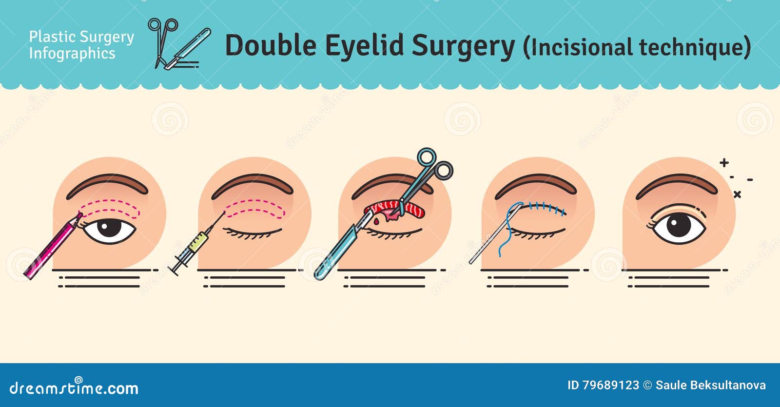  illustrated set with double eyelid surgery