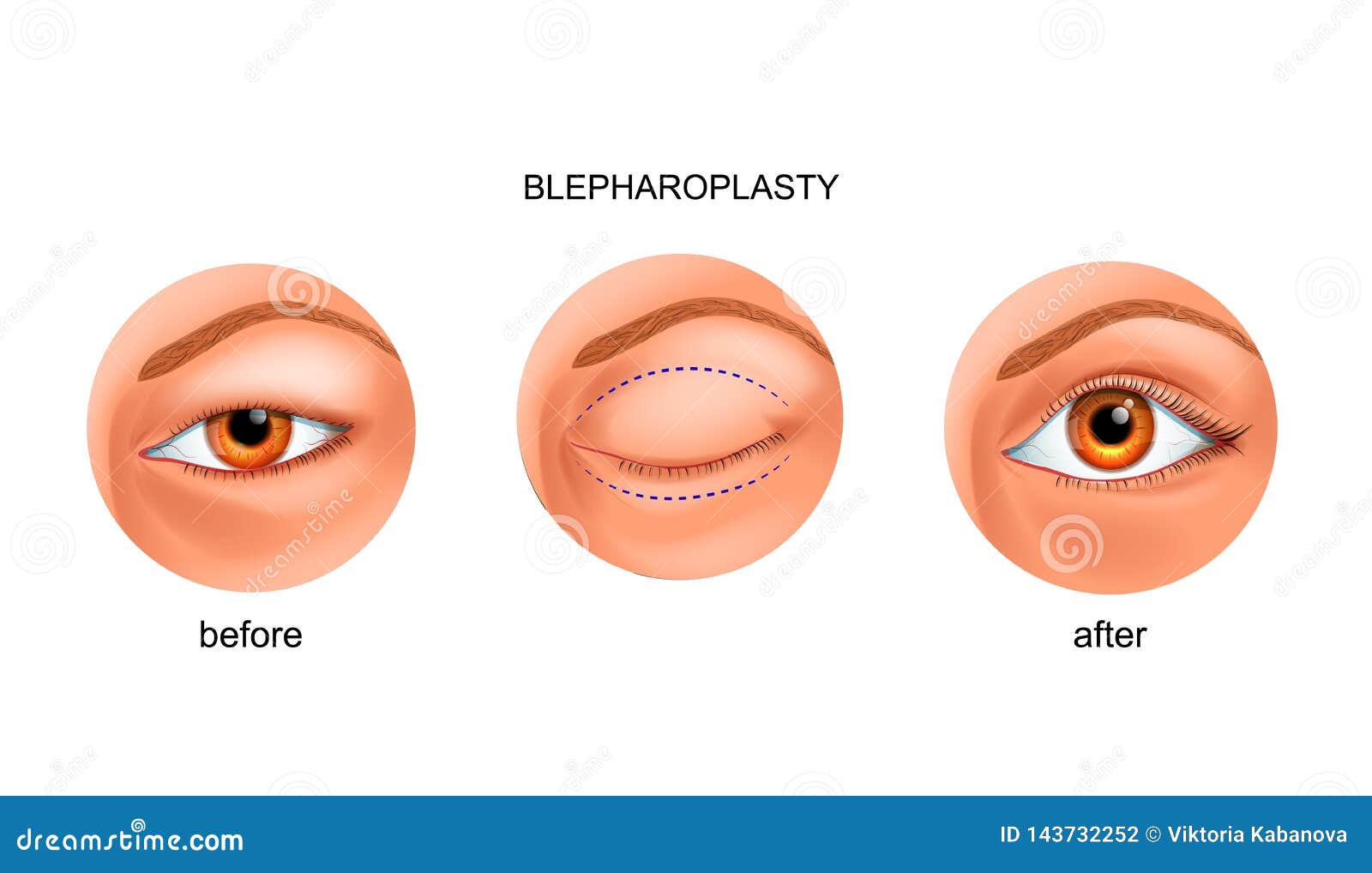 blepharoplasty of the asian eyelid