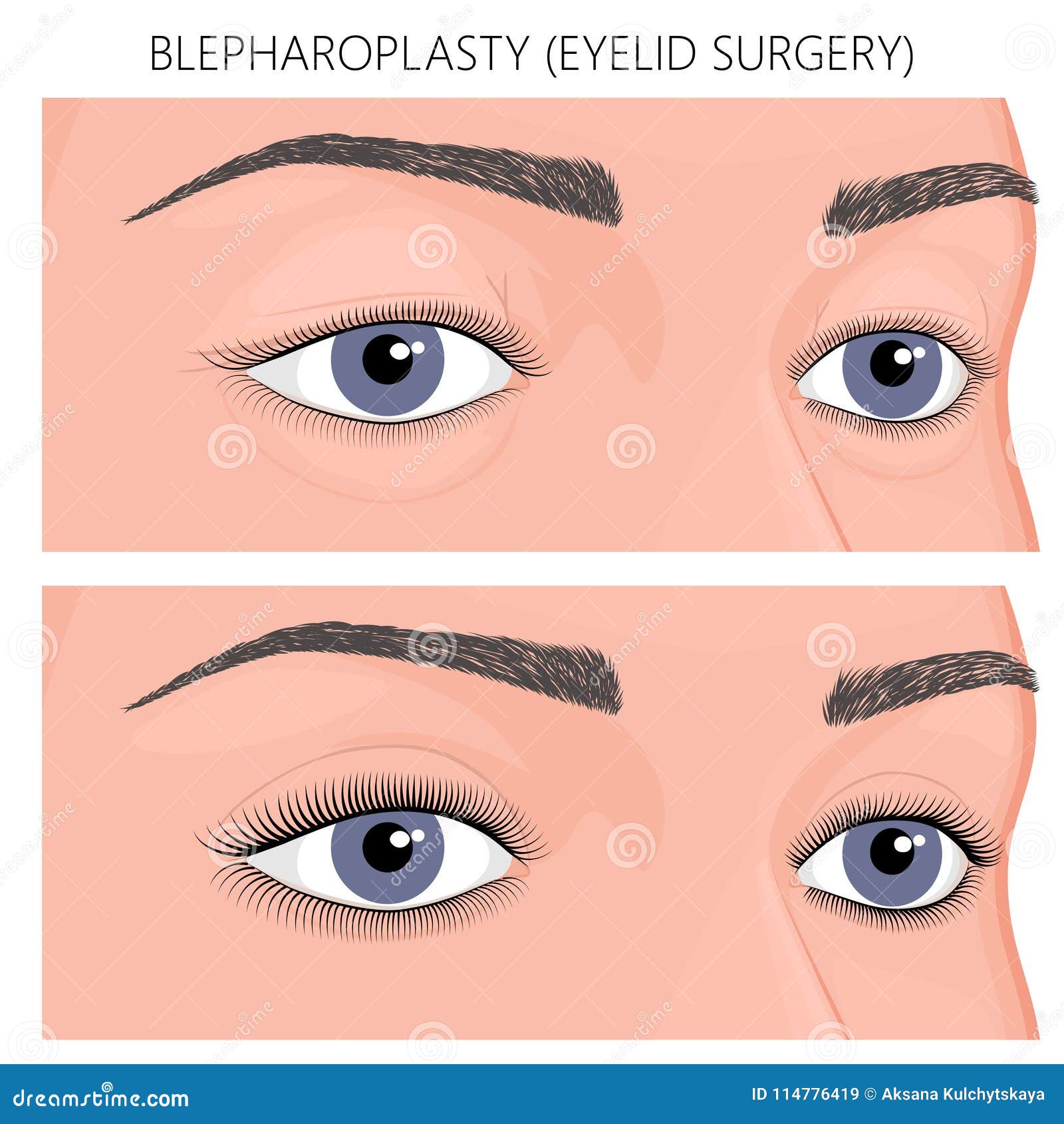plastic surgery_blepharoplasty eyelid surgery