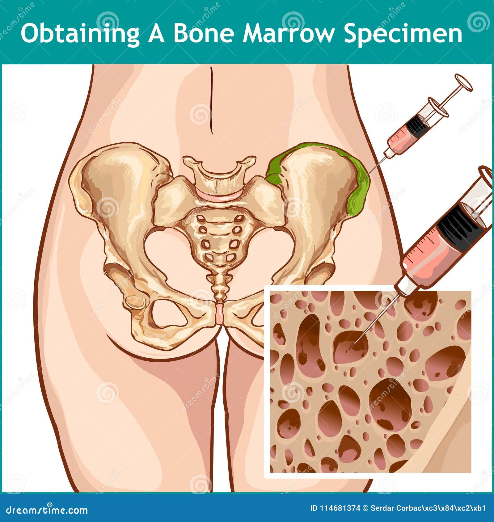 Pelvis Bone Marrow Stock Illustrations 15 Pelvis Bone Marrow Stock Illustrations Vectors Clipart Dreamstime