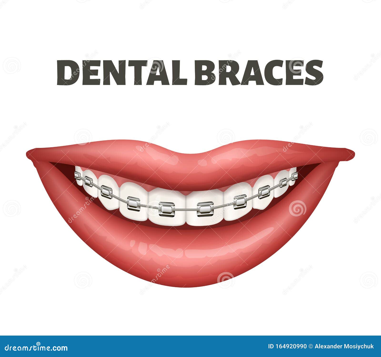Vector Illustration of the Dental Braces. Image Showing Human Smile and
