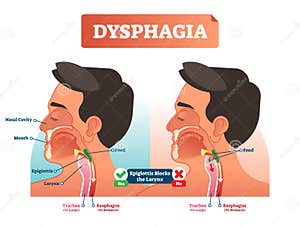 Dysphagia Stock Illustrations 293 Dysphagia Stock Illustrations 