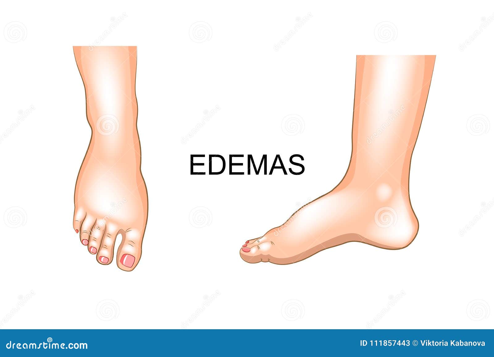 foot swelling. edema