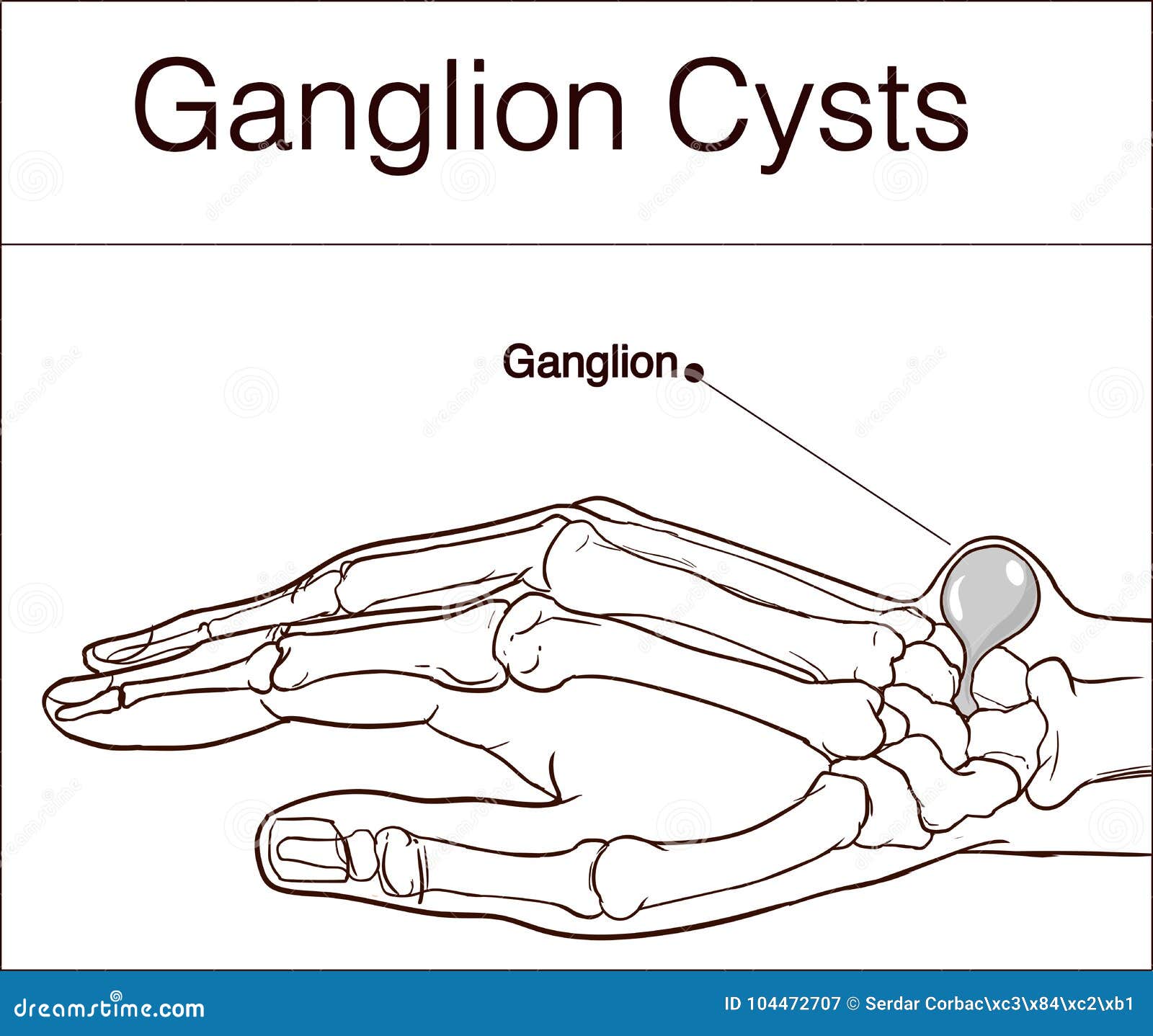 Ganglion Cartoons  Illustrations  U0026 Vector Stock Images