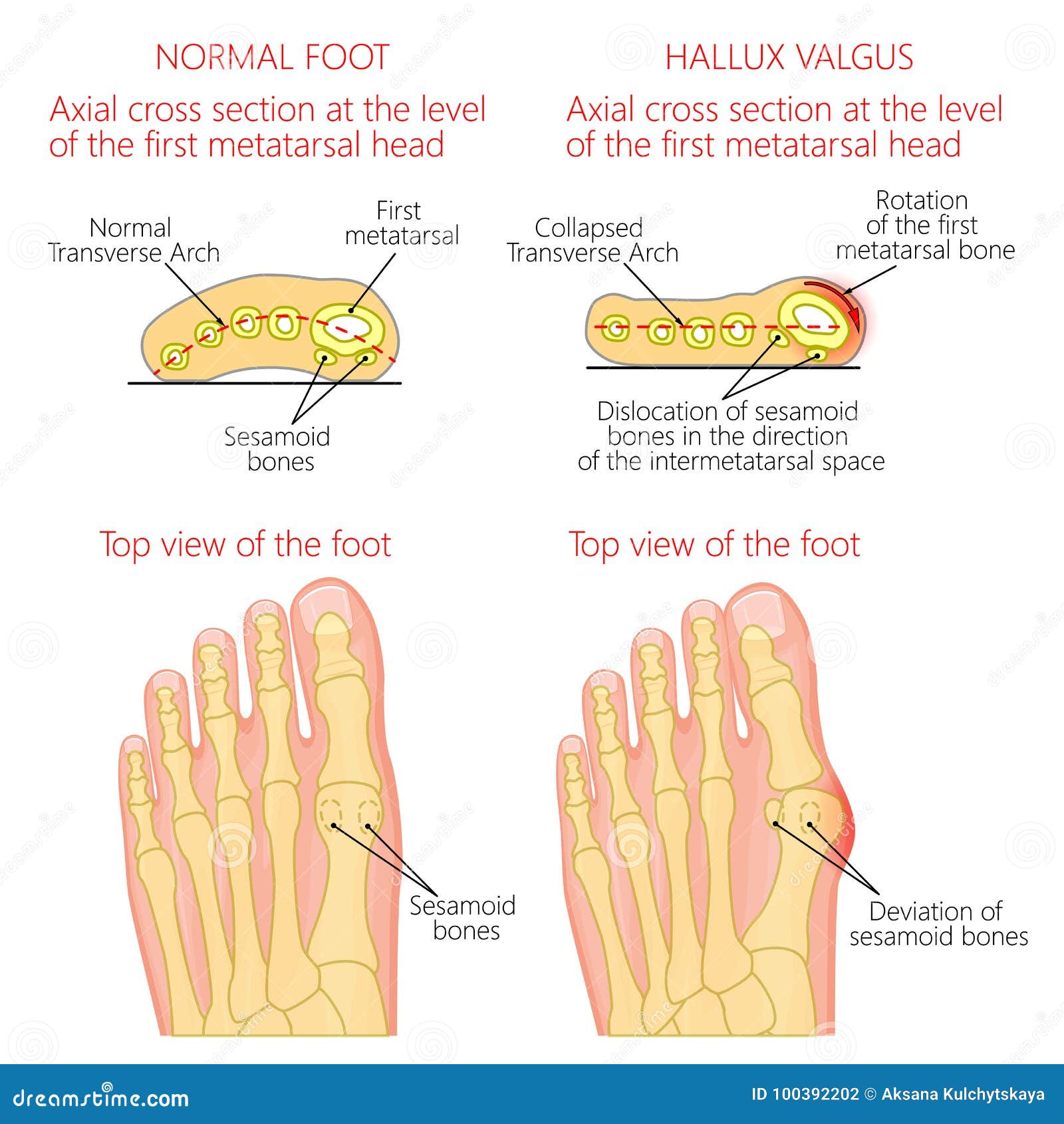 hallux-valgus-is-the-commonest-forefoot-deformity-stock-image