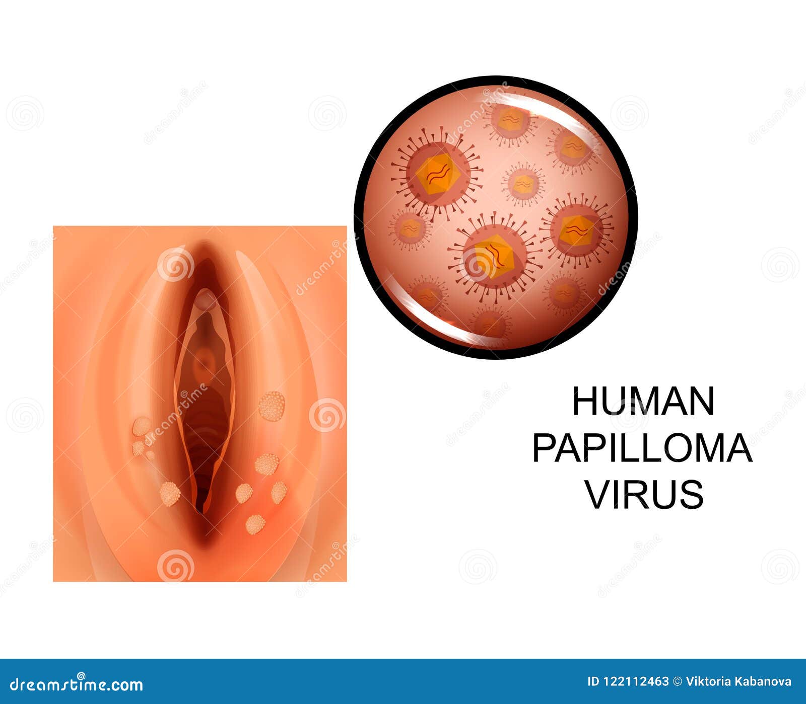 Infectia cu HPV: Cauze, simptome, tratament, preventie | Bioclinica