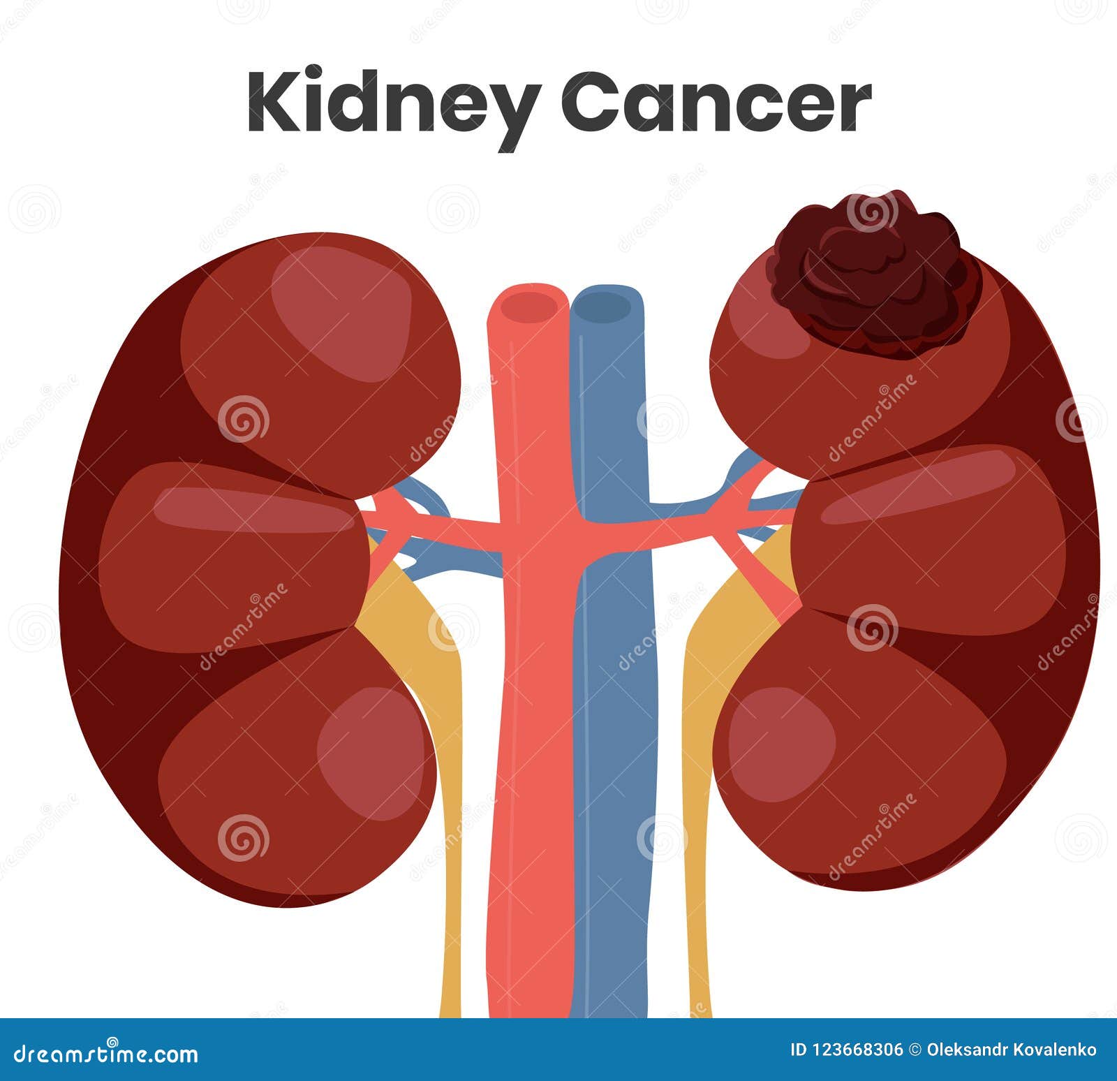   of the kidney cancer. the tumor is affecting left kidney while right kidney is normal