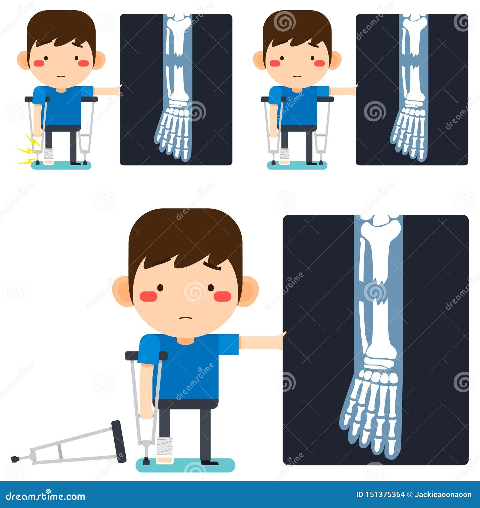 Leg X-ray Tiny Cute Cartoon Patient Man Character Right Leg Broken in  Gypsum Bandage or Plastered Leg Standing with Axillary Stock Vector -  Illustration of hand, bone: 151375364