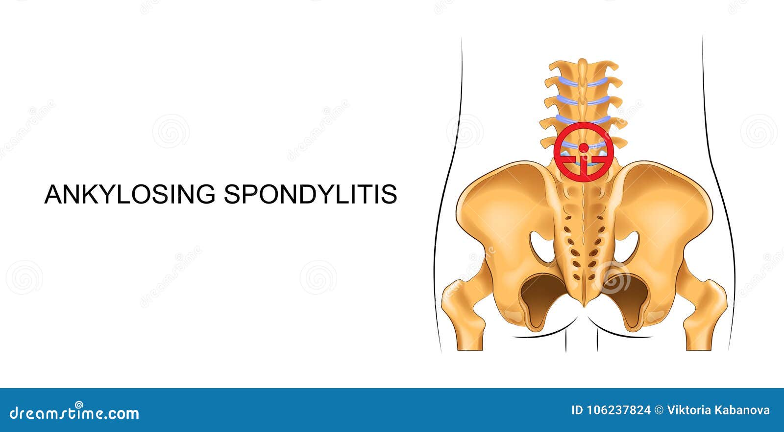 Lower Back, Suffering from Ankylosing Spondylitis Stock Vector