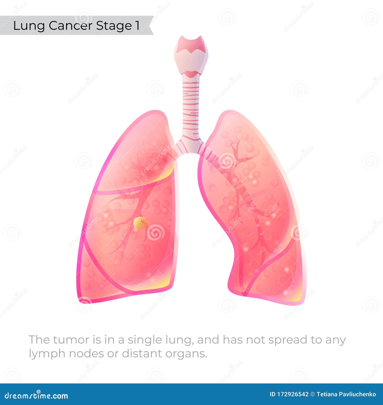 Vector Illustration of Lung Cancer Stock Vector - Illustration of ...