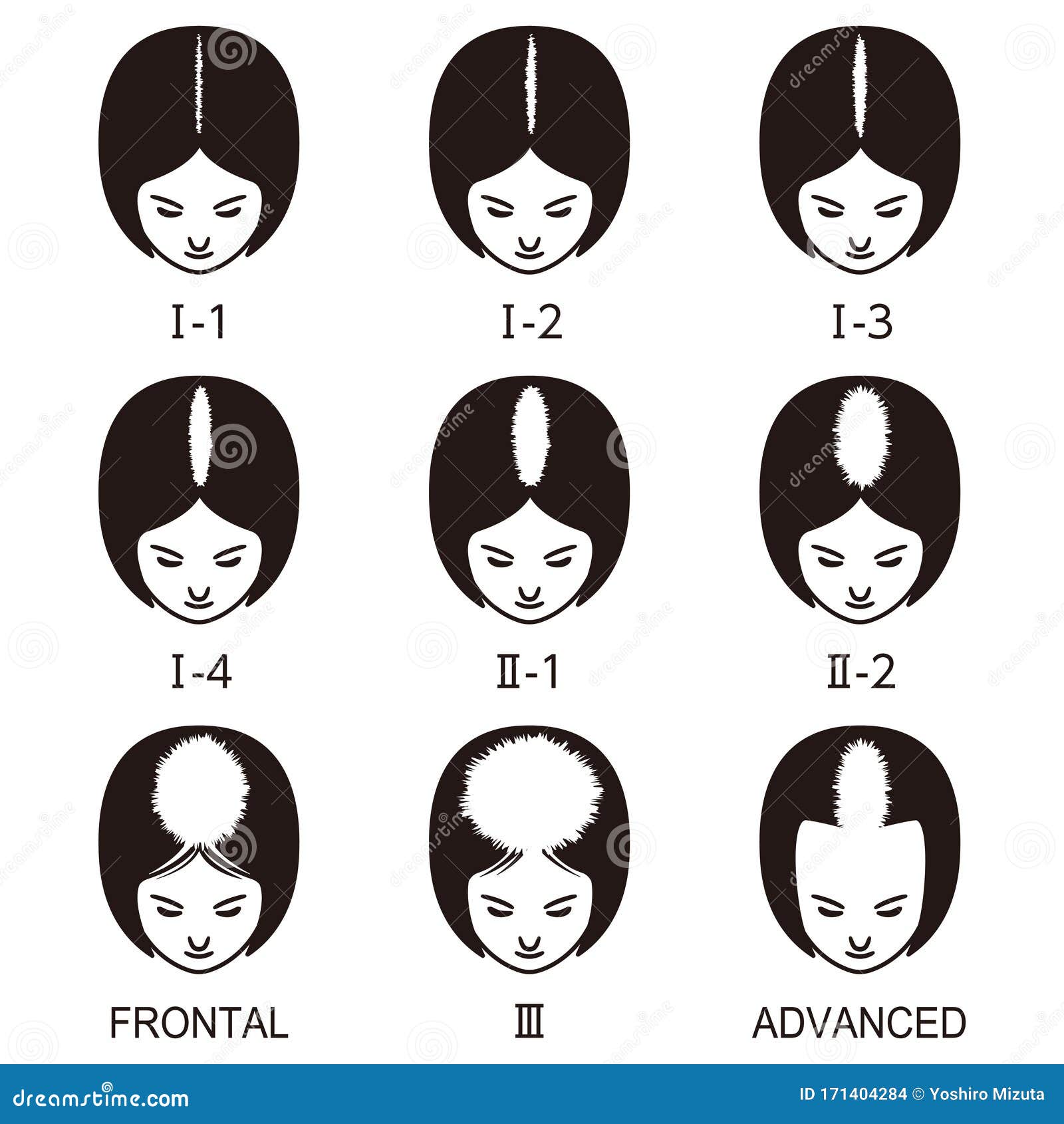 Norwood-Hamilton scale: the 7 stages of male pattern baldness