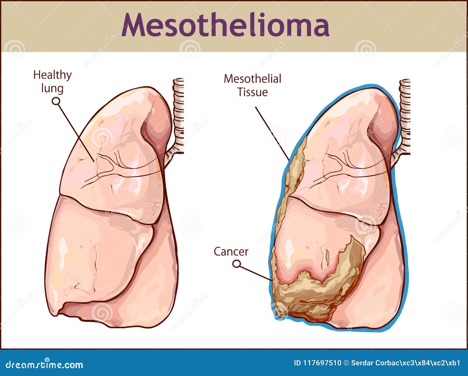 avastin in mesothelioma