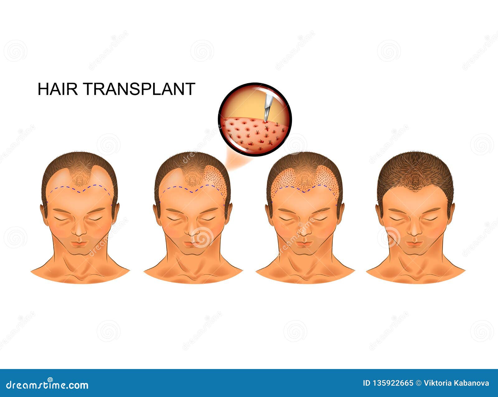 Process Hair Transplantation of the Occipital Part of the Head Stock Vector  - Illustration of male, hairstyle: 135922665