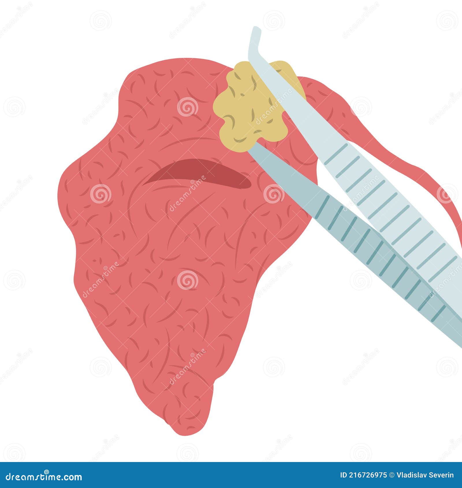   of removing a stone from the parotid salivary gland