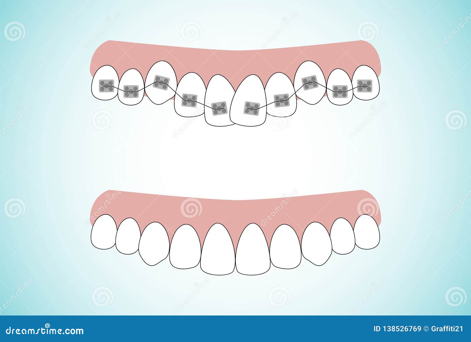 Vector Illustration of the Stages of Orthodontic Treatment Braces on