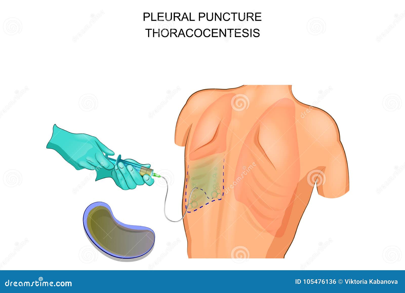 Thoracocentesis, Pleural Puncture Vector Illustration CartoonDealer