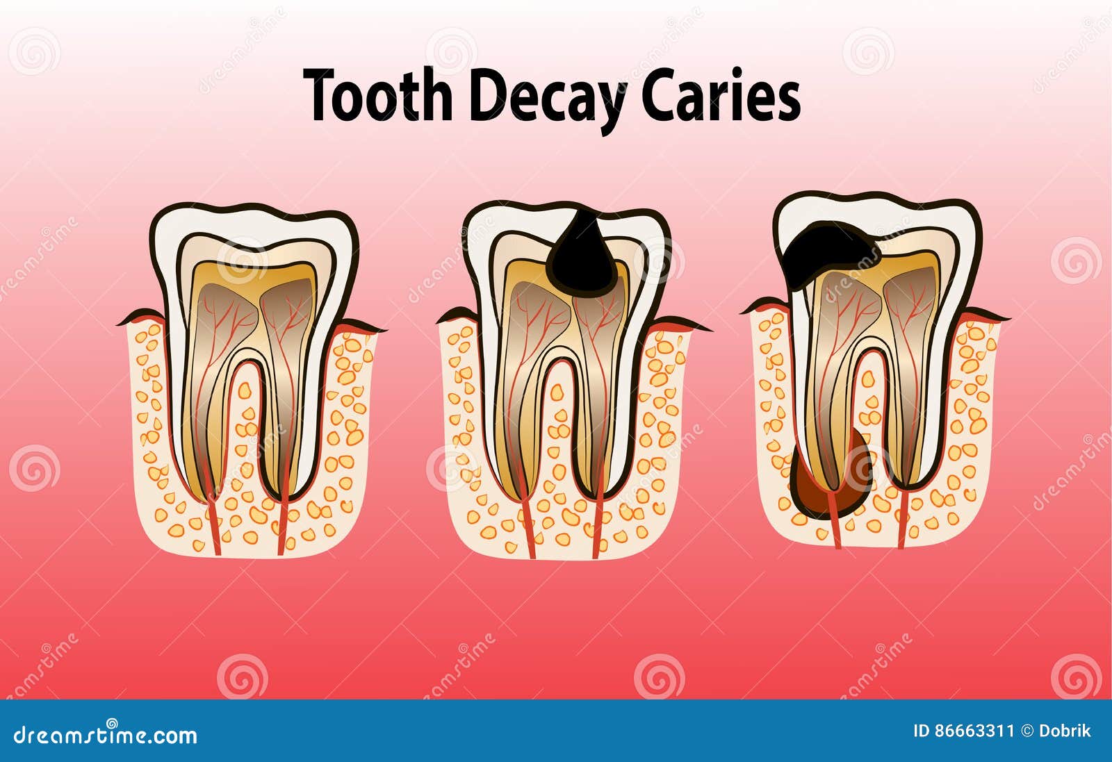 Stages Of Dental Disease. Treatment Of The Oral Cavity. Toothache