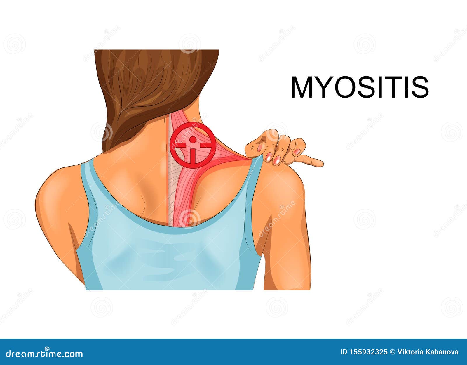 trapezius muscle. the incidence of myositis